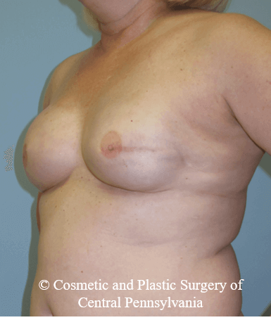 Breast Reconstruction After