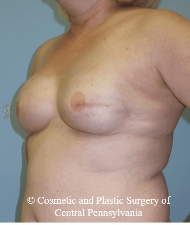 Breast Reconstruction After