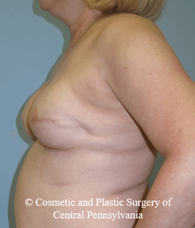 Breast Reconstruction After