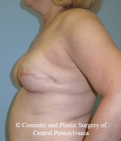 Breast Reconstruction After
