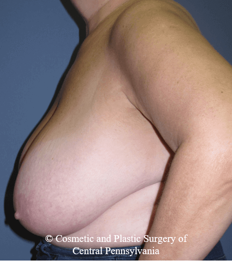 Breast Reduction Before