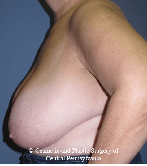 Breast Reduction Before