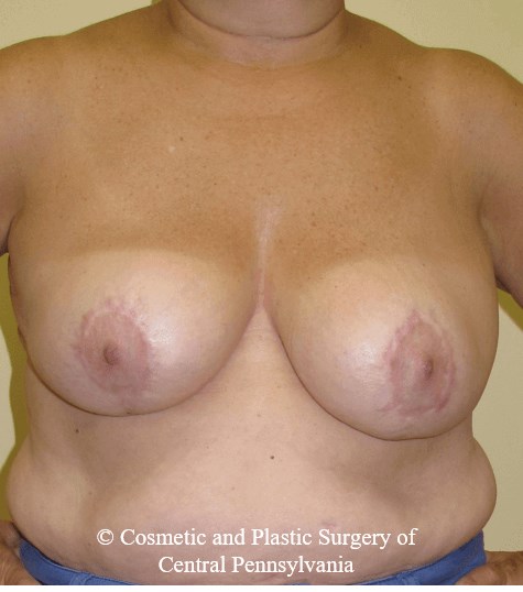 Breast Reduction After