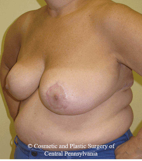 Breast Reduction After