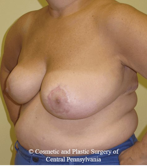 Breast Reduction After