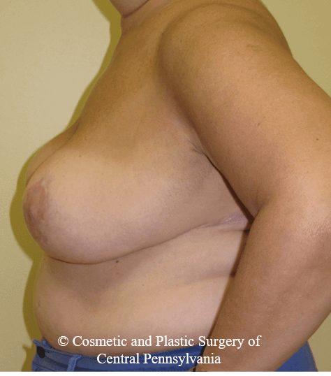 Breast Reduction After