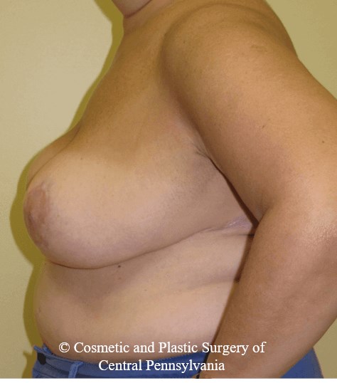 Breast Reduction After