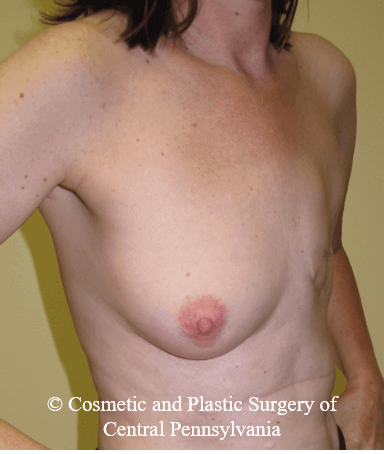 Breast Reconstruction Before
