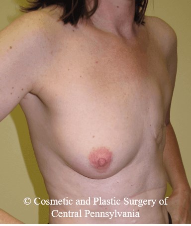 Breast Reconstruction Before