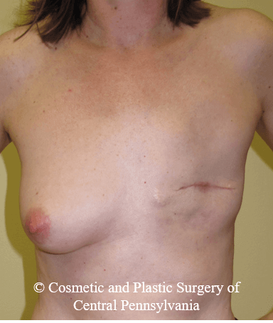 Breast Reconstruction Before