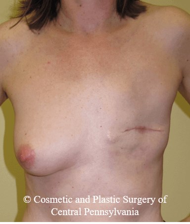 Breast Reconstruction Before
