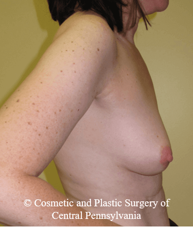 Breast Reconstruction Before