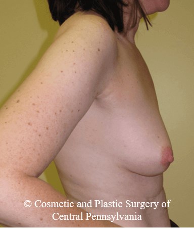 Breast Reconstruction Before