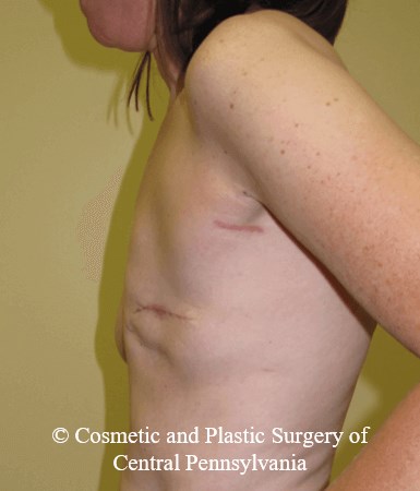 Breast Reconstruction Before