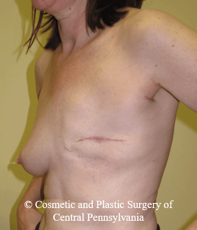 Breast Reconstruction Before