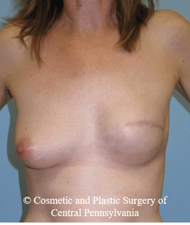 Breast Reconstruction After
