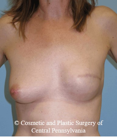 Breast Reconstruction After