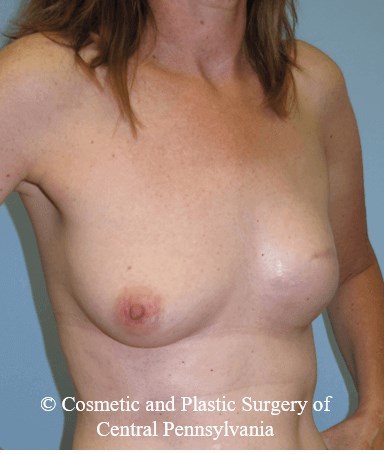 Breast Reconstruction After