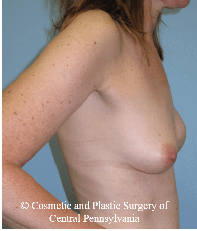 Breast Reconstruction After