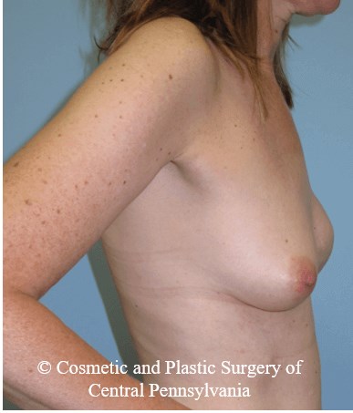 Breast Reconstruction After
