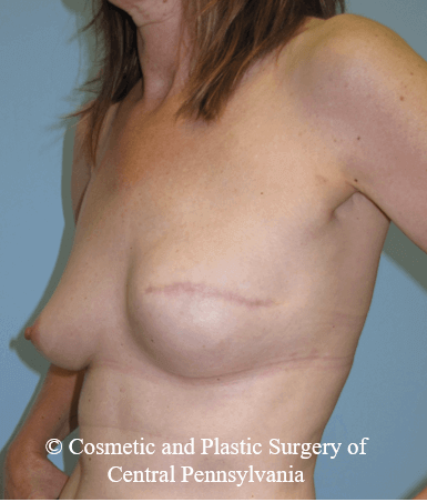 Breast Reconstruction After