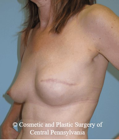 Breast Reconstruction After