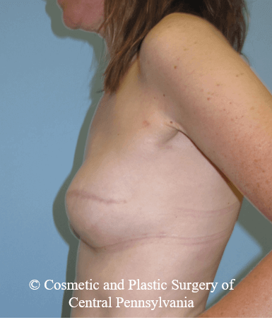 Breast Reconstruction After