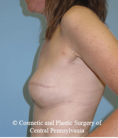 Breast Reconstruction After