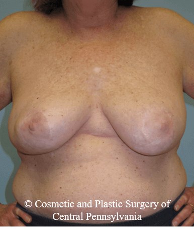 Breast Lift (Mastopexy) After