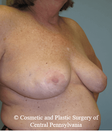 Breast Lift (Mastopexy) After