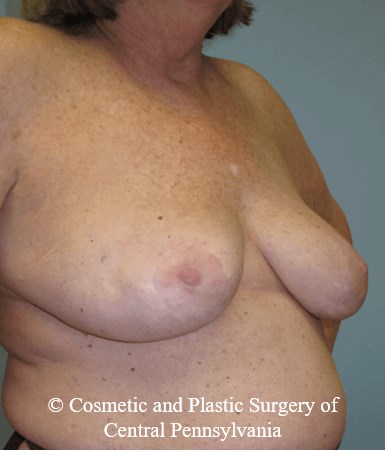 Breast Lift (Mastopexy) After