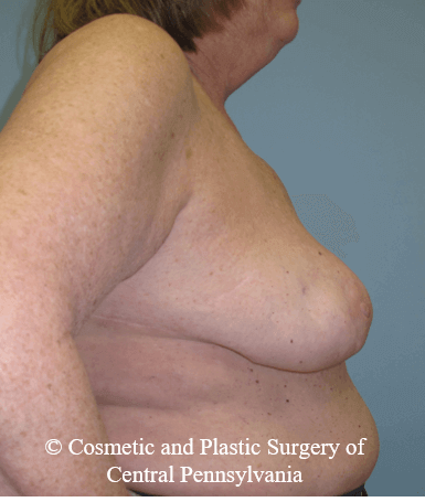 Breast Lift (Mastopexy) After