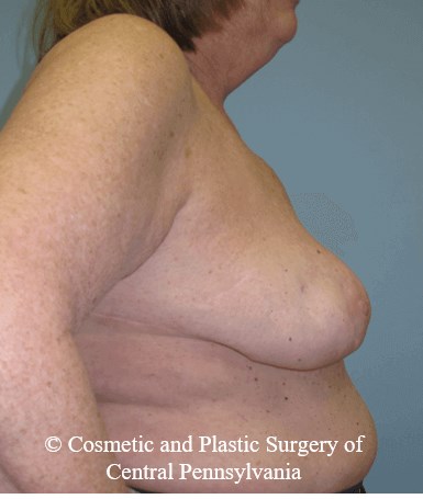 Breast Lift (Mastopexy) After