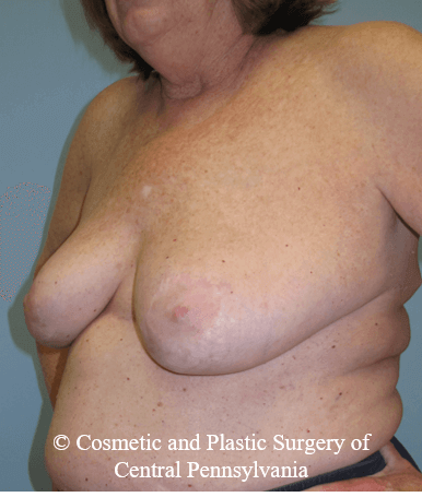 Breast Lift (Mastopexy) After