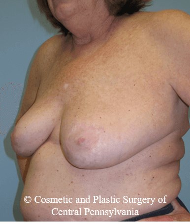 Breast Lift (Mastopexy) After