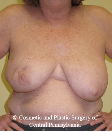 Breast Lift (Mastopexy) Before