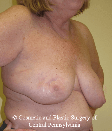 Breast Lift (Mastopexy) Before