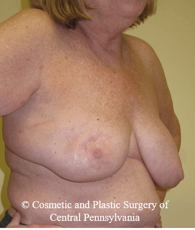 Breast Lift (Mastopexy) Before