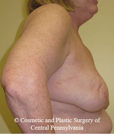 Breast Lift (Mastopexy) Before