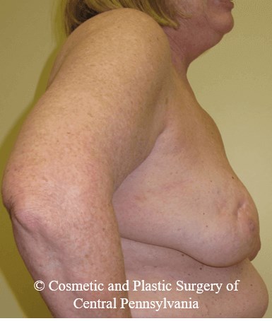 Breast Lift (Mastopexy) Before