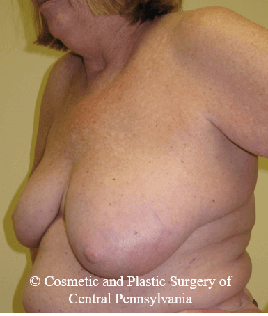 Breast Lift (Mastopexy) Before