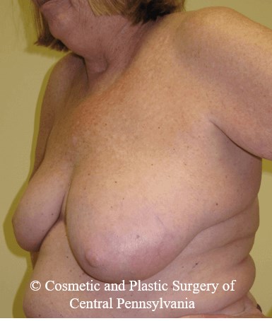 Breast Lift (Mastopexy) Before