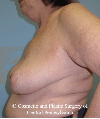 Breast Lift (Mastopexy) After
