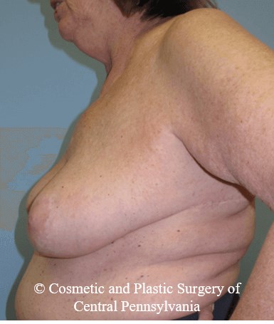 Breast Lift (Mastopexy) After