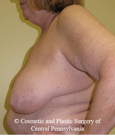 Breast Lift (Mastopexy) Before