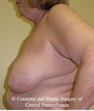 Breast Lift (Mastopexy) Before
