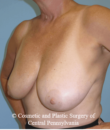 Breast Lift (Mastopexy) Before