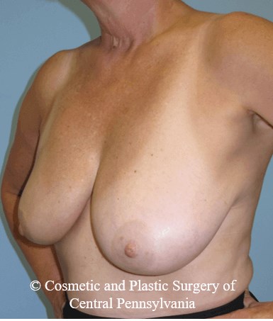 Breast Lift (Mastopexy) Before