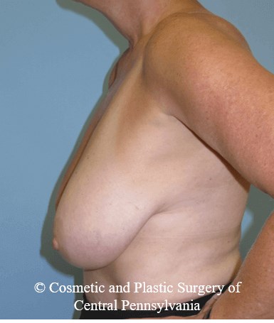 Breast Lift (Mastopexy) Before