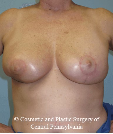 Breast Lift (Mastopexy) After